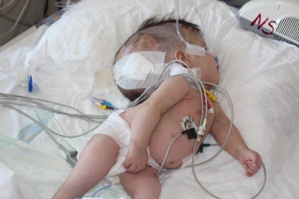 Hidrosefali hastası depremzede bebek, Antalya'da ameliyat edildi-5