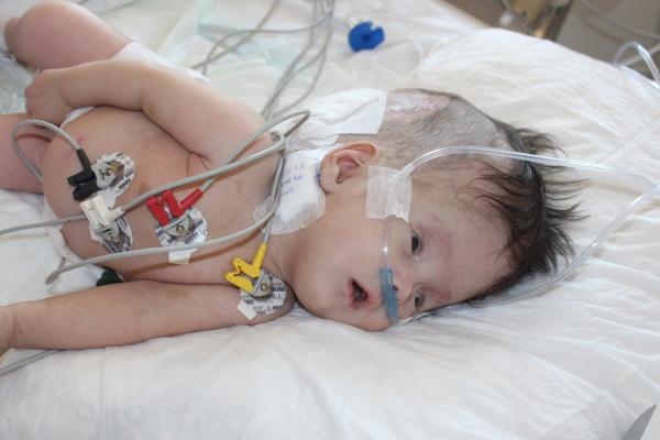 Hidrosefali hastası depremzede bebek, Antalya'da ameliyat edildi-6