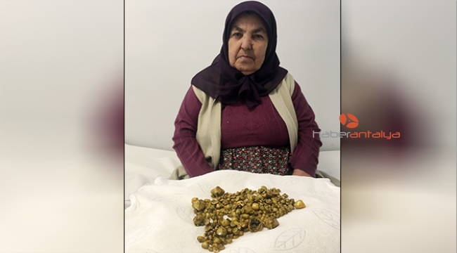 Safra kesesinden 311 taş çıktı