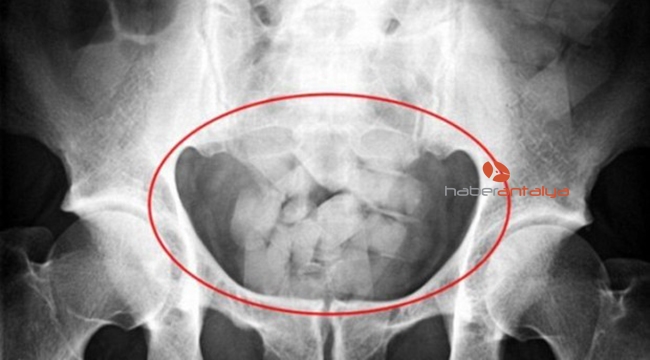 Havalimanında midesinde 370 gram eroinle yakalandı