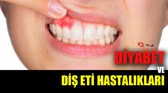 Diyabet Hastalarında Diş Eti Problemi 3 Kat Fazla Görülüyor