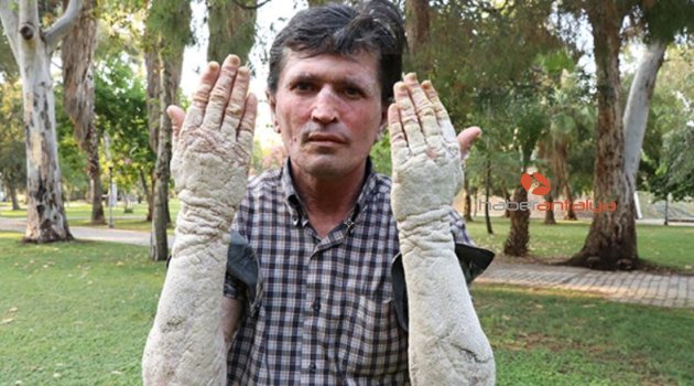 Hastalığı değil, insanların kendini görünce korkup uzaklaşması kahrediyor