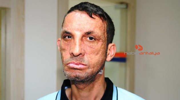 İlk yüz nakilli Uğur Acar'a 'cinayet' davasından beraat