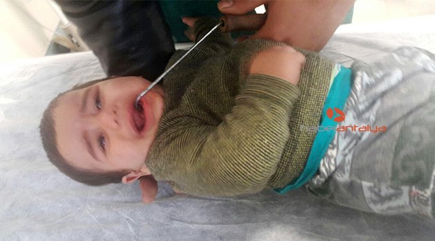 Minik Muhammed'in ağzına kova demiri saplandı