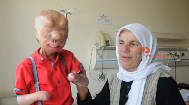 Yanık tedavisi gören Serkan ve Firdevs'e yardım yağıyor
